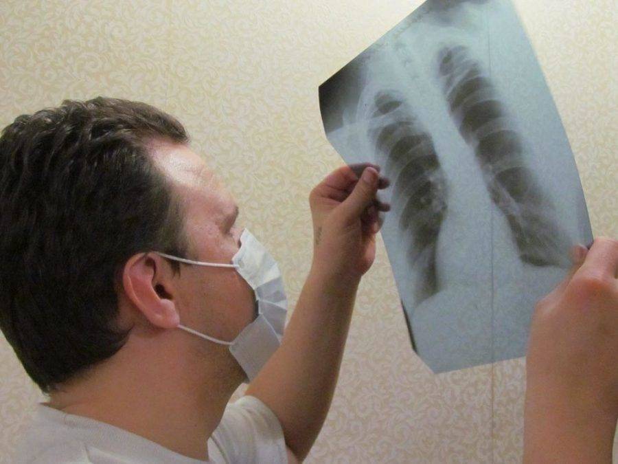На 36,6% снизилось количество заболевших туберкулезом в Якутии за год