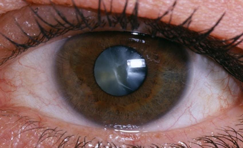9 декабря офтальмологи Якутской городской больницы №3 расскажут о катаракте