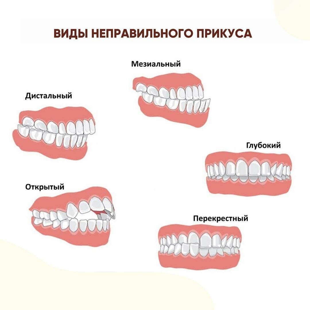 Все, что нужно знать о брекетах: показания, виды и цены | 27.02.2023 |  Якутск - БезФормата