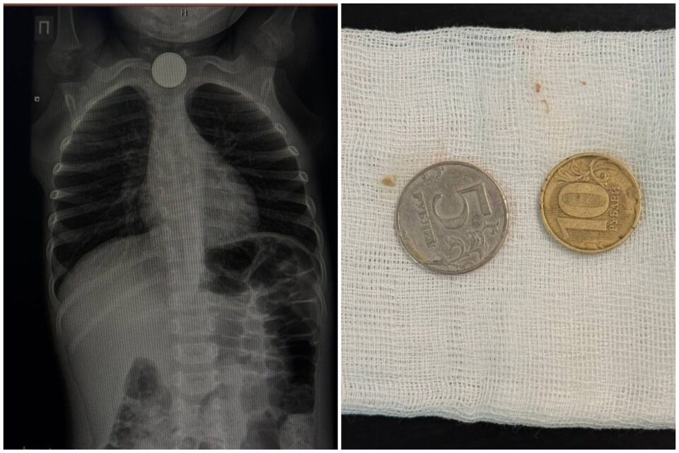 Две монеты из пищевода трехлетнего мальчика извлекли врачи в Якутске